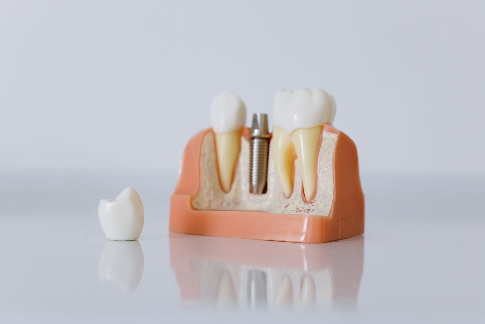 Modelo de implante dental